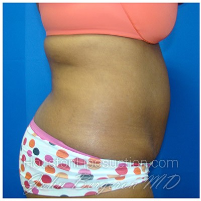 Liposuction before photo