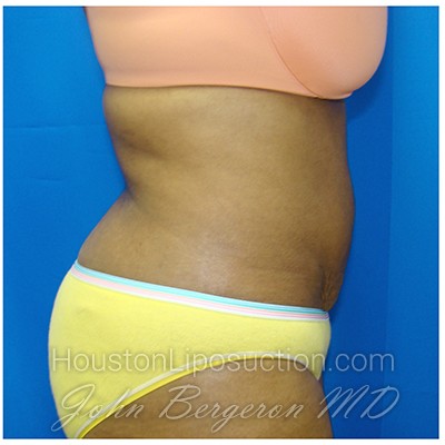 Liposuction after photo