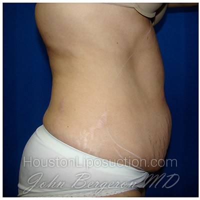 Liposuction before photo