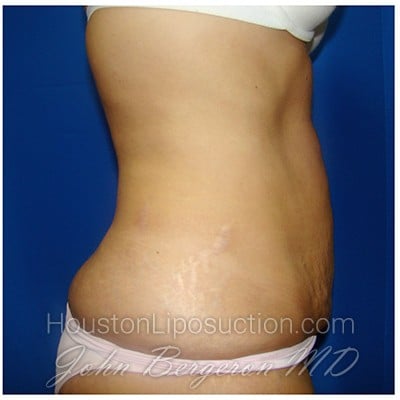 Liposuction after photo