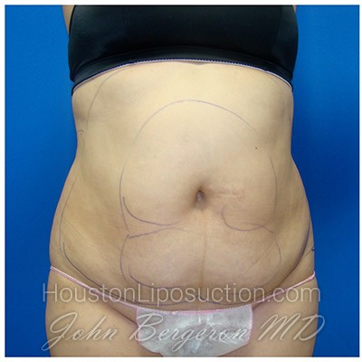 Liposuction before photo
