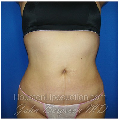Liposuction after photo