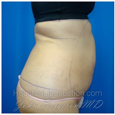 Liposuction before photo