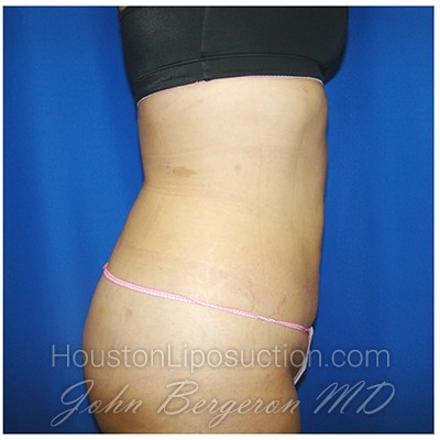 Liposuction after photo
