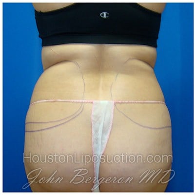 Liposuction before photo