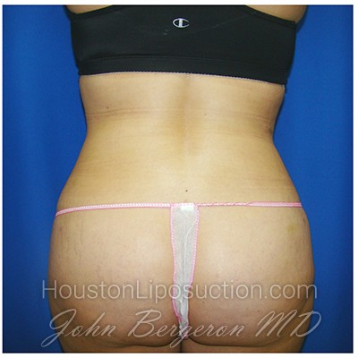 Liposuction after photo