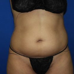 Liposuction before photo