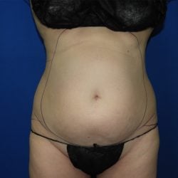 Liposuction before photo
