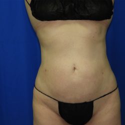Liposuction after photo