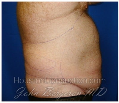Liposuction before photo