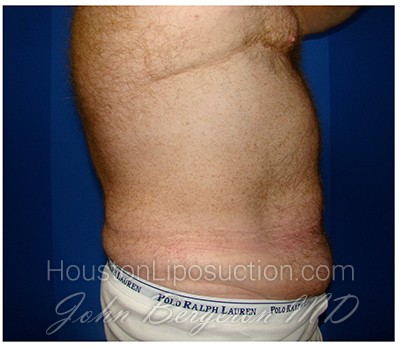Liposuction after photo