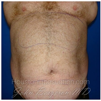 Liposuction before photo