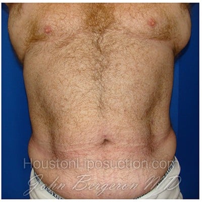 Liposuction after photo