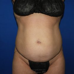 Liposuction before photo