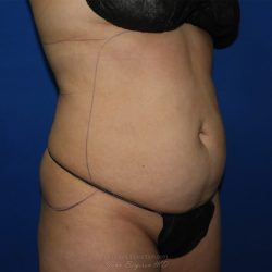 Liposuction before photo