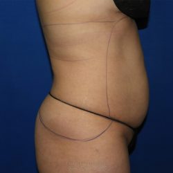 Liposuction before photo
