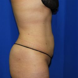 Liposuction after photo