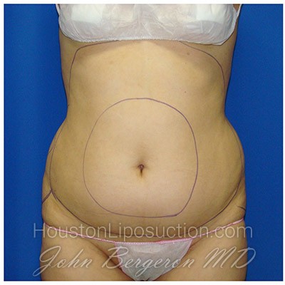 Liposuction before photo