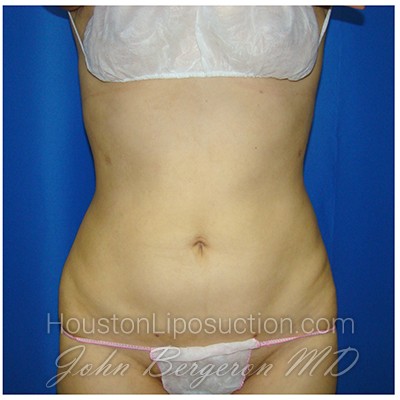 Liposuction after photo