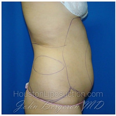 Liposuction before photo