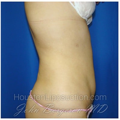 Liposuction after photo
