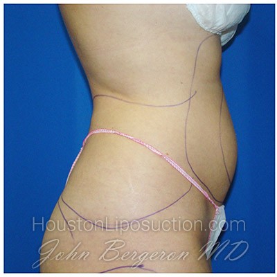 Liposuction before photo