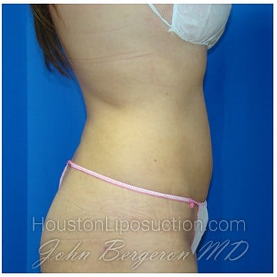 Liposuction after photo