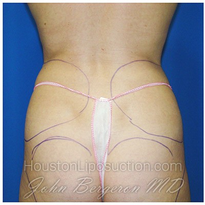 Liposuction before photo