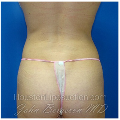 Liposuction after photo