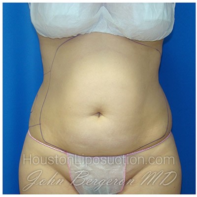 Liposuction before photo