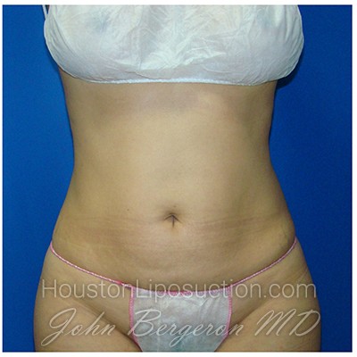 Liposuction after photo