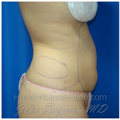 Liposuction before photo