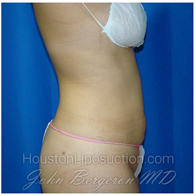 Liposuction after photo