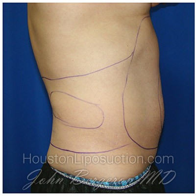 Liposuction before photo