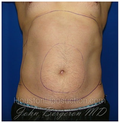 Liposuction before photo