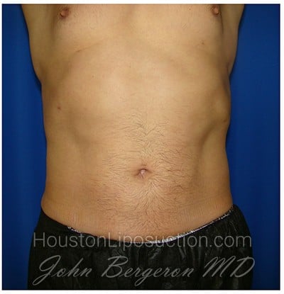 Liposuction after photo