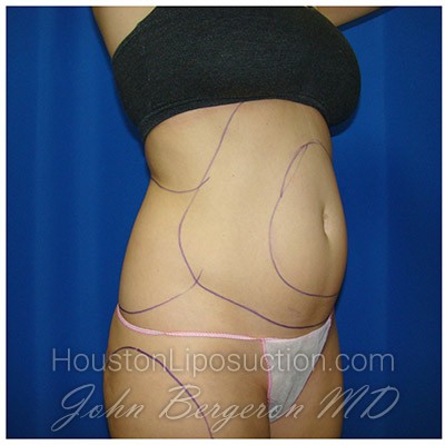 Liposuction before photo
