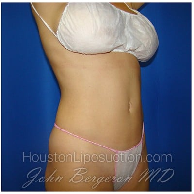 Liposuction after photo