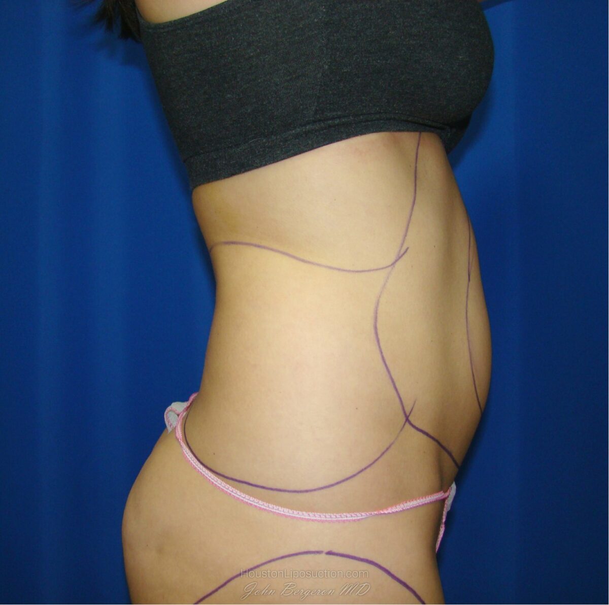 Liposuction before photo