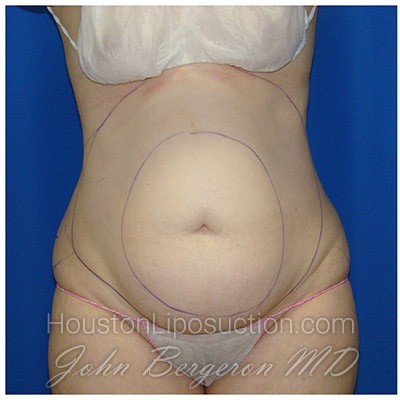 Liposuction before photo