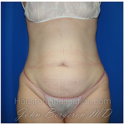 Liposuction after photo