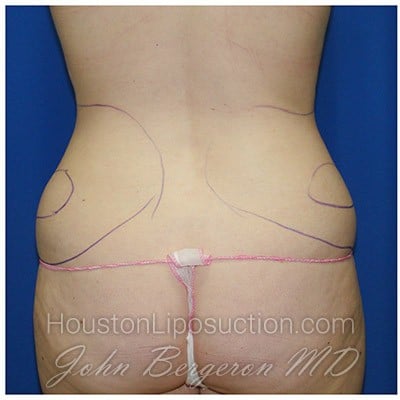 Liposuction before photo