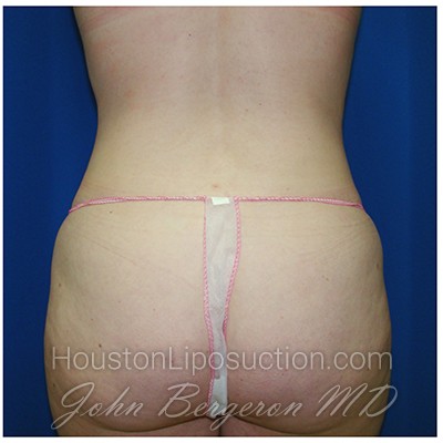 Liposuction after photo