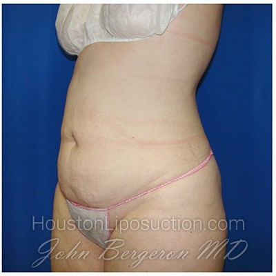 Liposuction before photo
