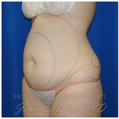Liposuction after photo