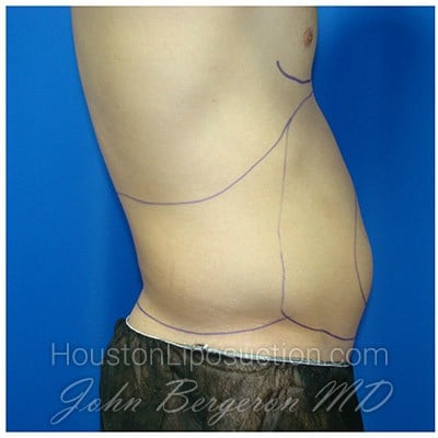 Liposuction before photo