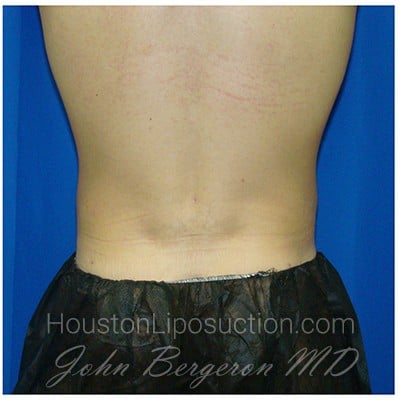 Liposuction after photo