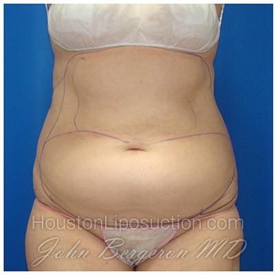 Liposuction before photo