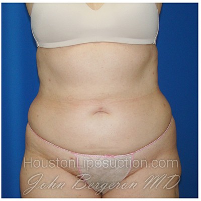 Liposuction after photo