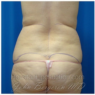 Liposuction before photo